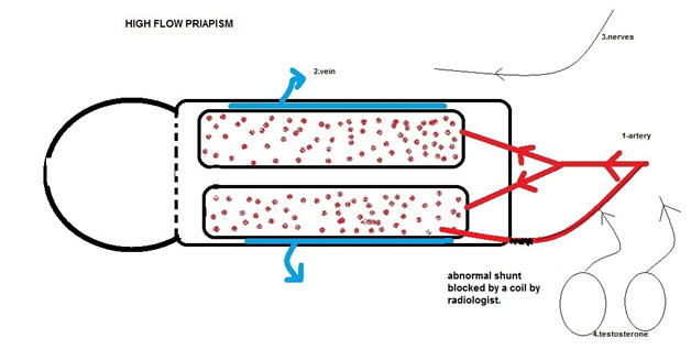 High-Flow (Non-Ischemic) Priapism