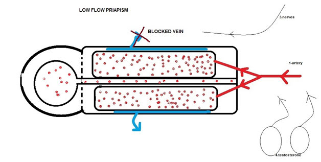 Low-Flow (Ischemic) Priapism