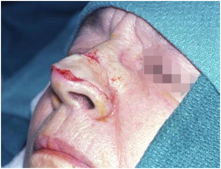 skin grafts for burn