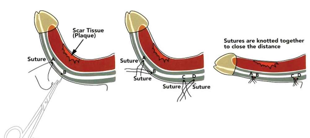 Treat Peyronie Disease