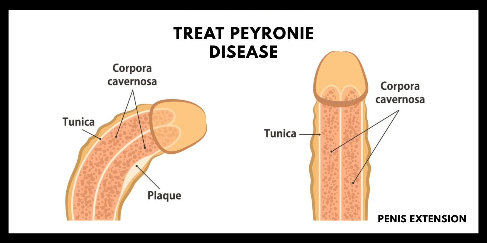 Peyronie's disease therapy options